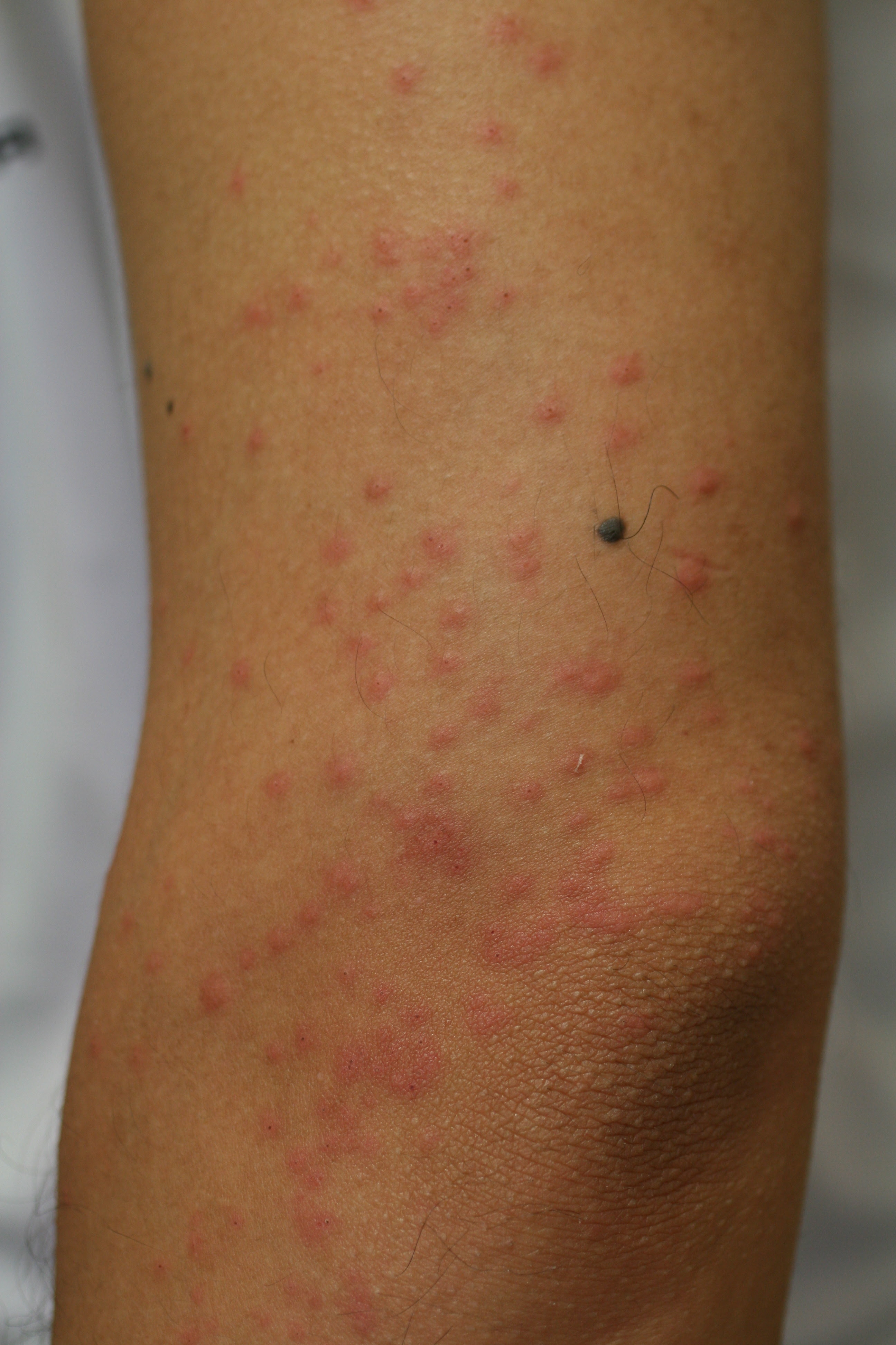 虫刺症ちゅうししょう 虫刺され