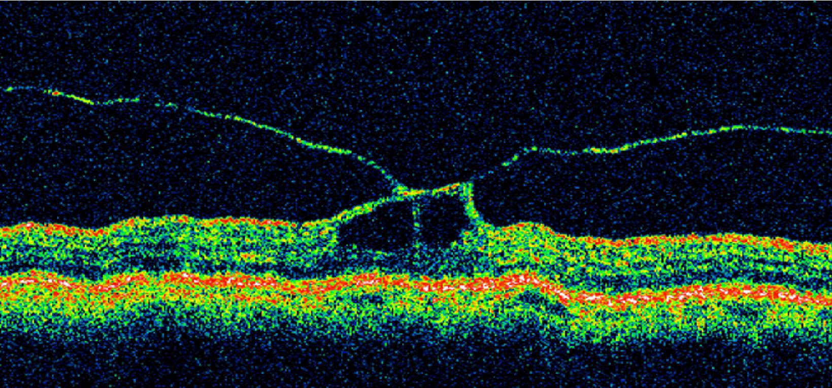 Posterior Vitreous Detachment: Evolution and Complications of Its 
