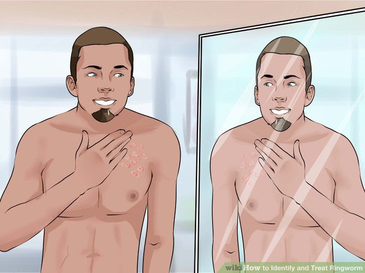 Identify and Treat Ringworm Step 3.jpg