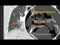 RS Case 02 : A patient presented with a progressively worsening SOB