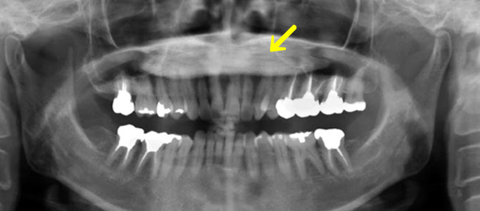静岡市葵区の歯医者 みまつ渡辺歯科 1273 58歳女性 口蓋隆起の存在 口腔外科で外科的に除去