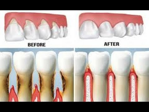 Receding Gums: Causes, Treatment, Surgery, and Prevention