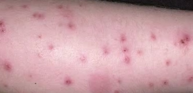 Bed Bug Bite â Pictures, Symptoms, Treatment