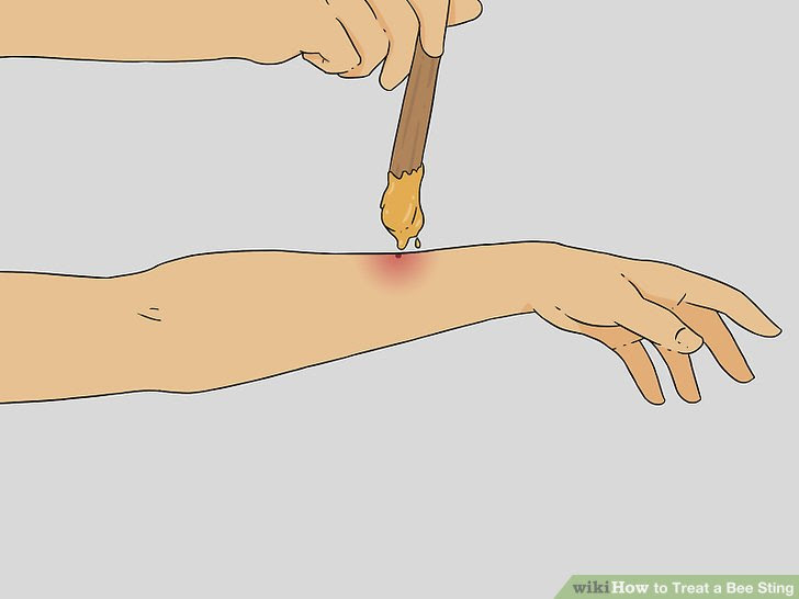 Treat a Bee Sting Step 8 Version 3.jpg