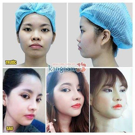 Nâng mũi bằng sườn sụn4