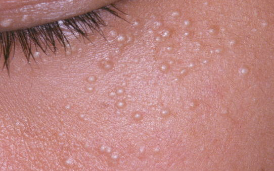 5 アトピー性皮膚炎の診断 アトピー性皮膚炎でよくみられる症状 前半はこちら 目次 1 アトピー肌 2 白色皮膚描記 びょうき 症 3 毛孔性苔癬 たいせん 4 肥厚性瘢痕 ひこうせいはんこん 5 はたけ 小児乾燥性湿疹 6 足底皮膚炎 ズック
