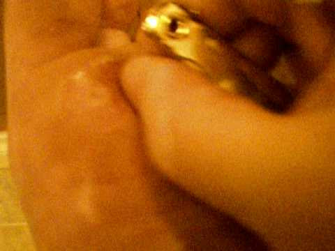 plantar wart. Plantar wart skin removal with