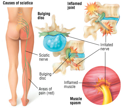 Sciatica? Psoriatic Arthritis Flare Up in My SI Joint??