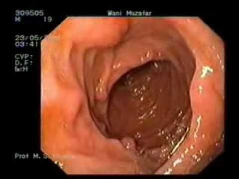 uterine cancer with normal pap smear