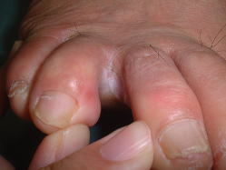 水虫の治療 品川のあおよこ皮膚科クリニックにお任せ