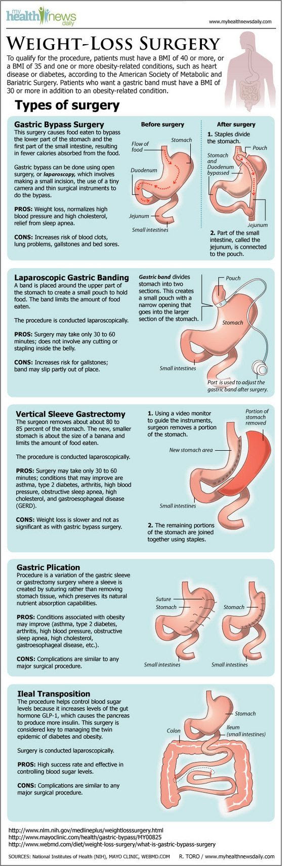 Types Of Bariatric Surgery Weight Loss