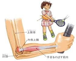 最近増えています テニス肘