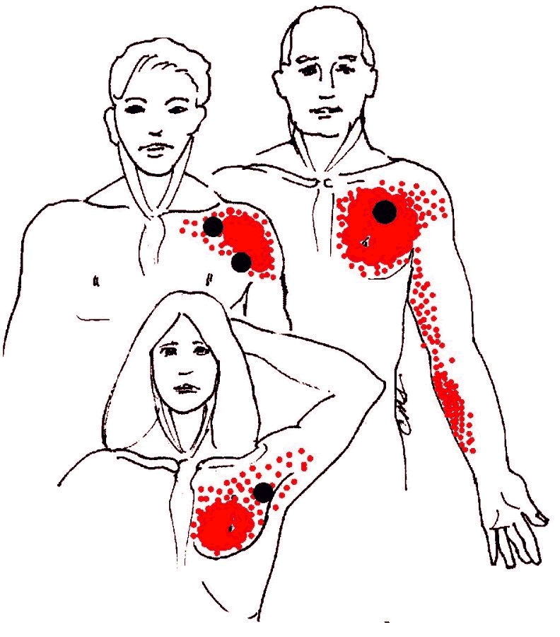 ROUND EARTH PUBLISHING: INTRODUCTION TO SHOULDER PAIN