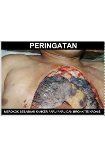 Inilah 5 Gambar  Seram yang Bakal Ada di Bungkus Rokok  
