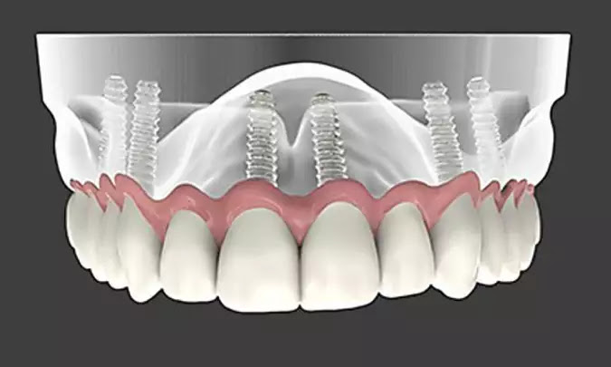 This is What Dental Implants Should Cost in Massachusetts