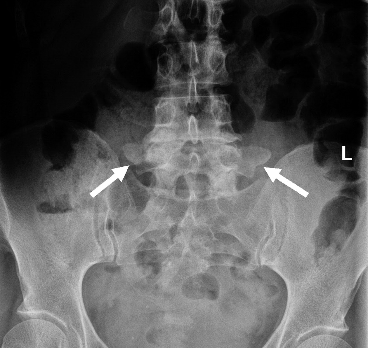 Lumbosacral Transitional Vertebrae Classification Imaging Findings And Clinical Relevance American Journal Of Neuroradiology
