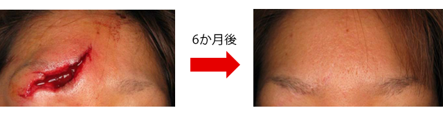 対象疾患 瘢痕 ケロイド 日本大学医学部 形成外科学系形成外科学分野