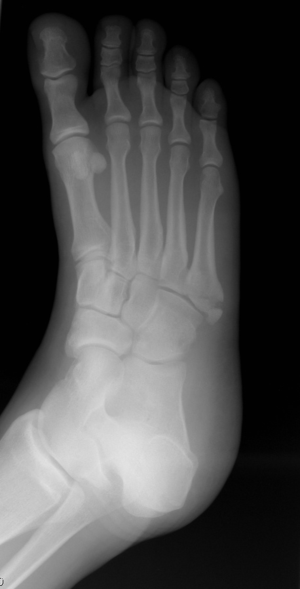 A fracture of the fifth metatarsal of the foot...