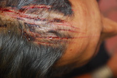 My Head Wound  Kama Zani by firoze shakir photographerno1