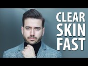 Viral Acne Tips for Guys most popullar!