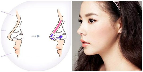 Chi phí nâng mũi Hàn Quốc ở Hà Nội bao nhiêu tiền? 4