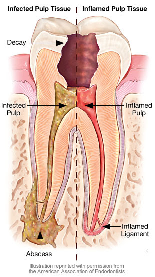 Severe pain in wisdom tooth area