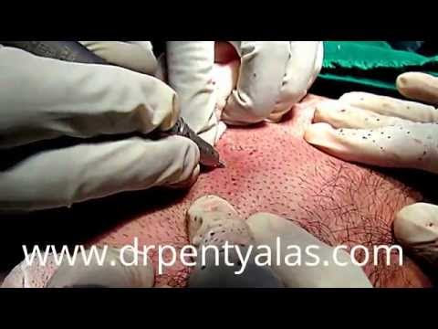 Body Hair Transplant Surgery