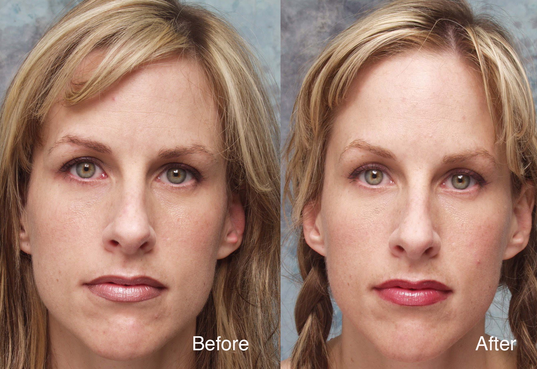 Botox Case Studies Beverly Hills | Dysport Beverly Hills ...