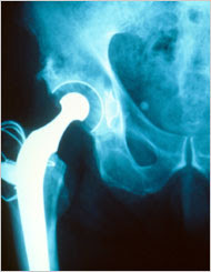 Cautious Optimism for Sufferers of Joint Pain