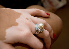  Vitiligo  