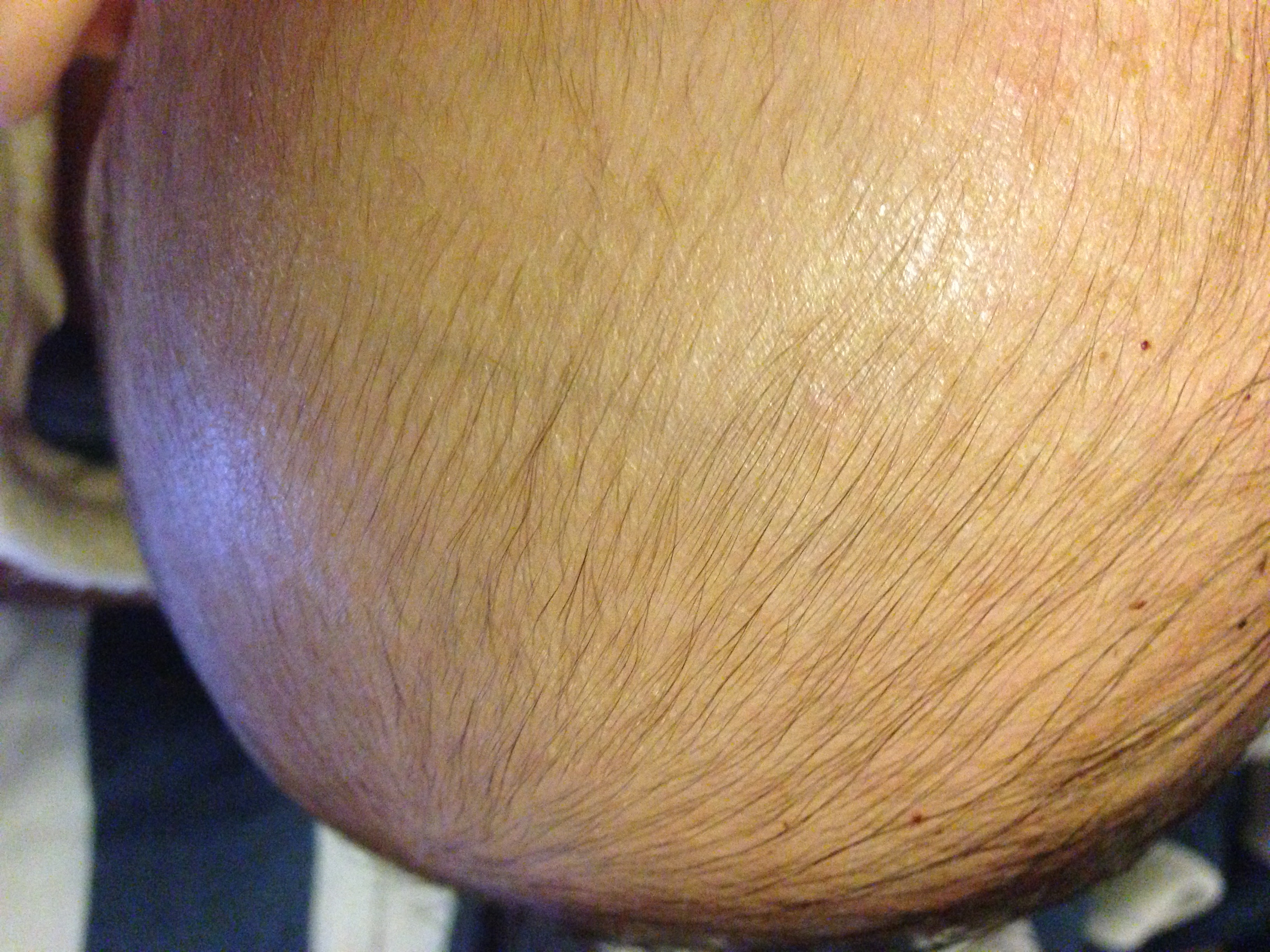 A Quick & Easy Way to Get Rid of Cradle Cap  Weather 