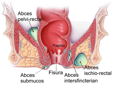 Tratament Fisura Anala Cu Toxina Botulinica