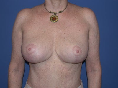 Before And After Breast Lift. Breast lift: Before amp; After