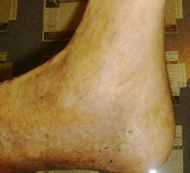 phlebitis 2
