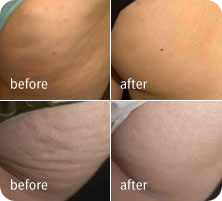 Does Truth About Cellulite Work?
