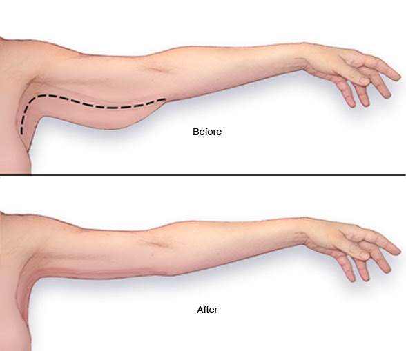 Ways You Can Reduce Arm Fat - AllDayChic