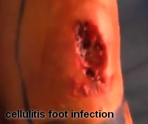 Cellulitis. Everything You Need to Know about Cellulitis
