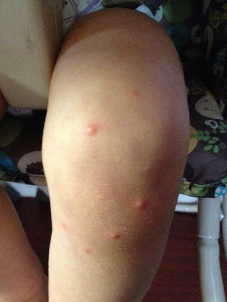 flea bites on toddlers MEMEs