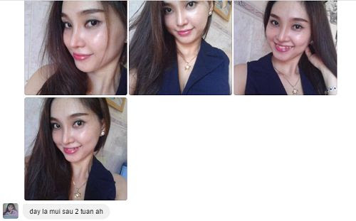 hình ảnh nâng mũi Hàn Quốc-13