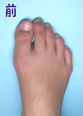 足指開きテープ ハルデージ