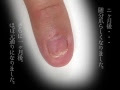200以上 爪 剥がれ た あと 197334-爪 剥がれたあと