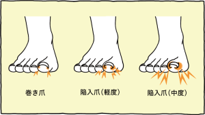 足の指が痛い 原因 と 場所 から分類します 足のお悩み百科