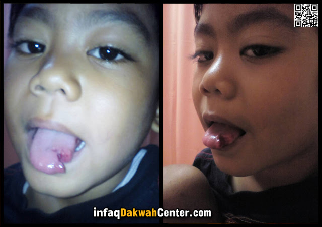 Tertabrak Motor, Lidah Fauzan Sobek Separo Butuh Biaya 