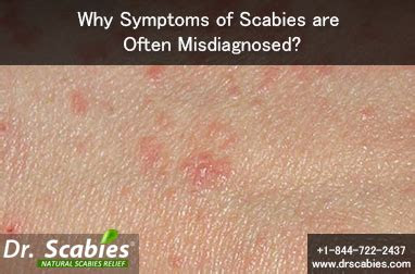 symptoms  scabies   misdiagnosed drscabies