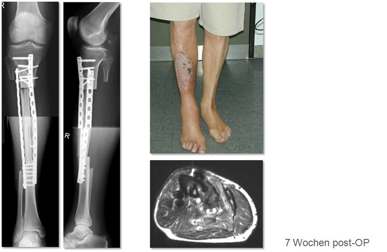 Osteosarkom Tumororthopaedie