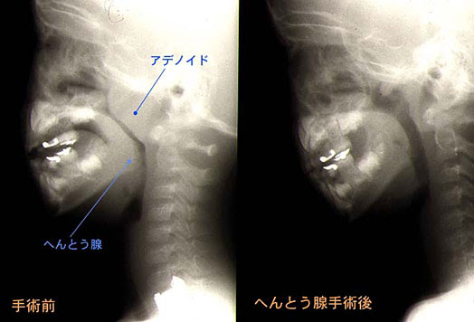 こどものいびき 睡眠健康大学