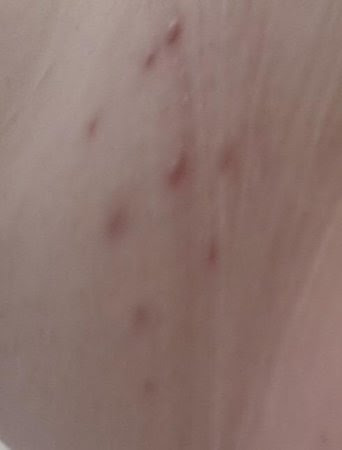 Allergic reaction to the Bed bug bites after 4 days on medication ...