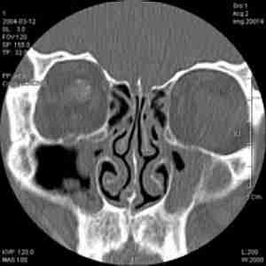 CT scan through eyes, nose