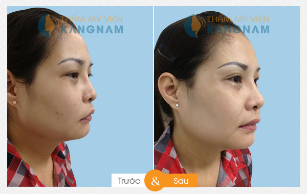 Phẫu thuật nâng mũi S-line ở đâu đẹp và an toàn nhất?