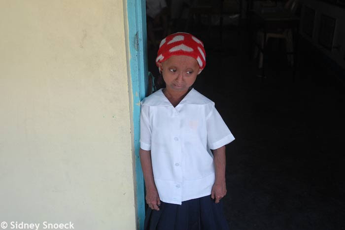 Rochelle progeria premature aging Philippines DSC_0423b
